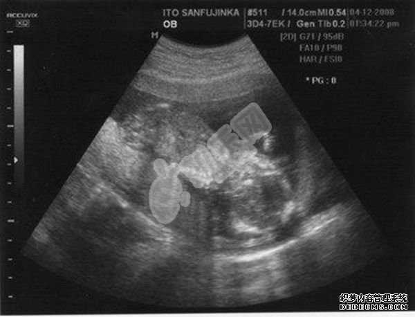 杭州代怀孕网具体位置,剖腹产月子的注意事项
