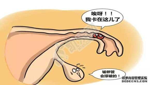 杭州助孕价格实惠,孕妇的痔疮的5个原因