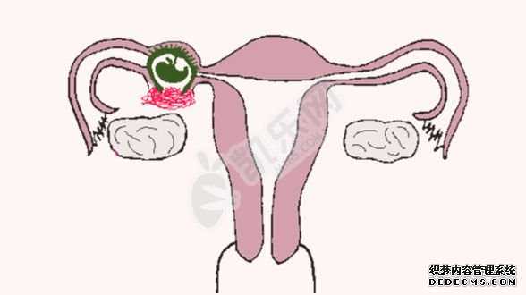 杭州代怀孕代孕套餐,多少周会发生前置胎盘的症状