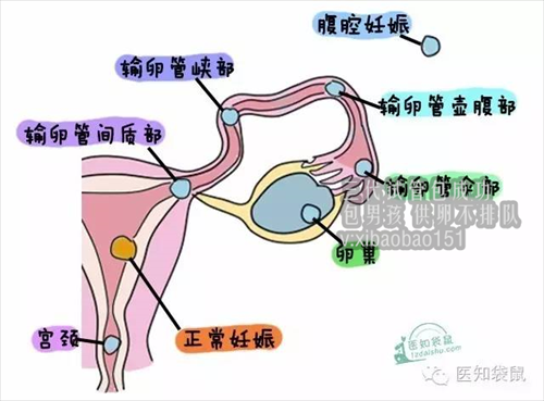 杭州代怀孕捐卵女生,冬天孕妇该如何预防感冒