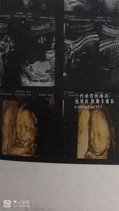 杭州代怀孕价网站,武汉省妇幼保健院试管成功率高吗